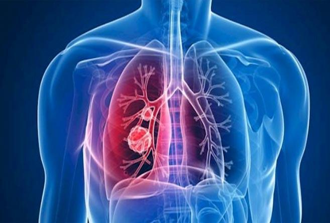 Rio Grande do Norte está acima da média de cura no Brasil da Tuberculose