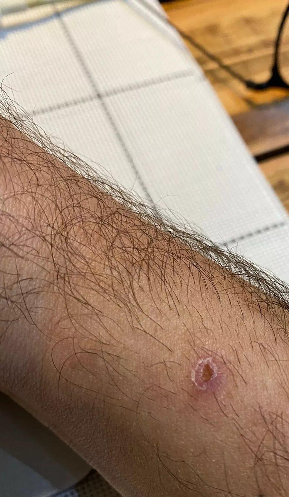 Secretaria de Saúde do Piauí investiga 15 casos suspeitos de varíola dos macacos