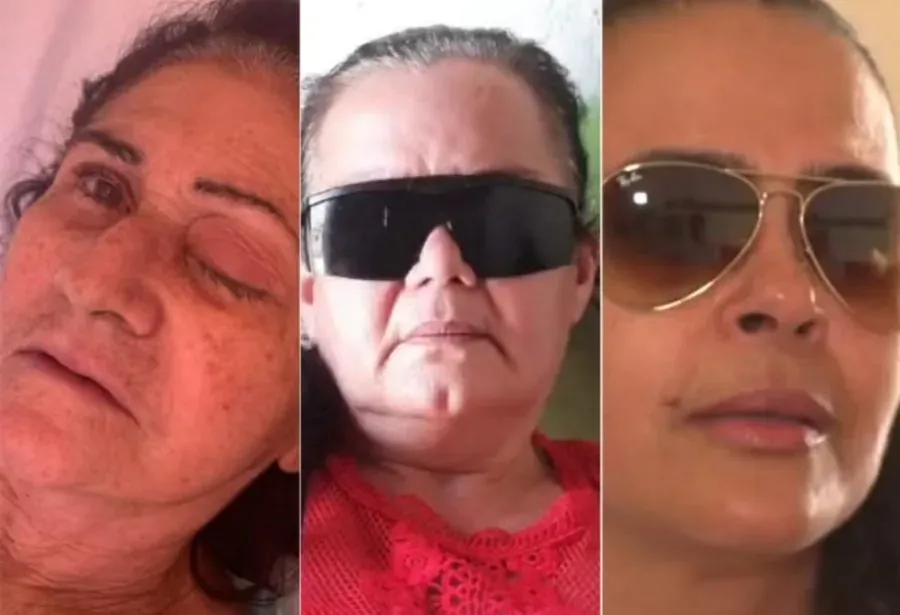 Número de pacientes que perderam o globo ocular após mutirão de catarata sobe para 10