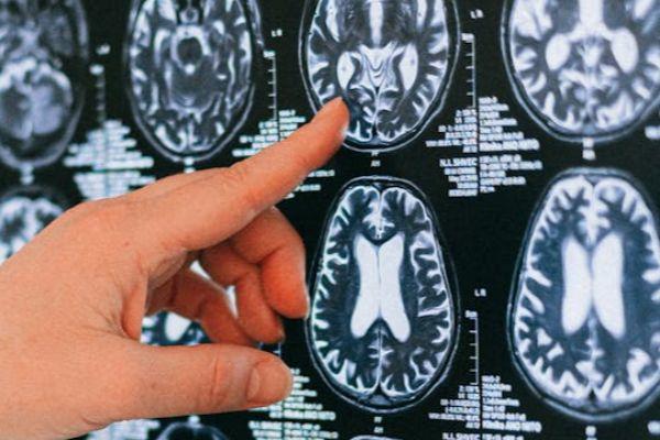 Plano de saúde é condenado por negar tratamento a criança com epilepsia no RN