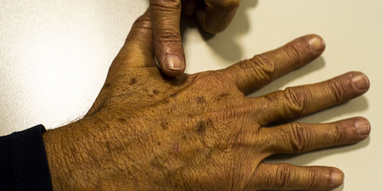 Falta de dados sobre câncer de pele impacta diagnóstico, aponta Fundação